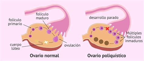 que es el ovario poliquistico-4